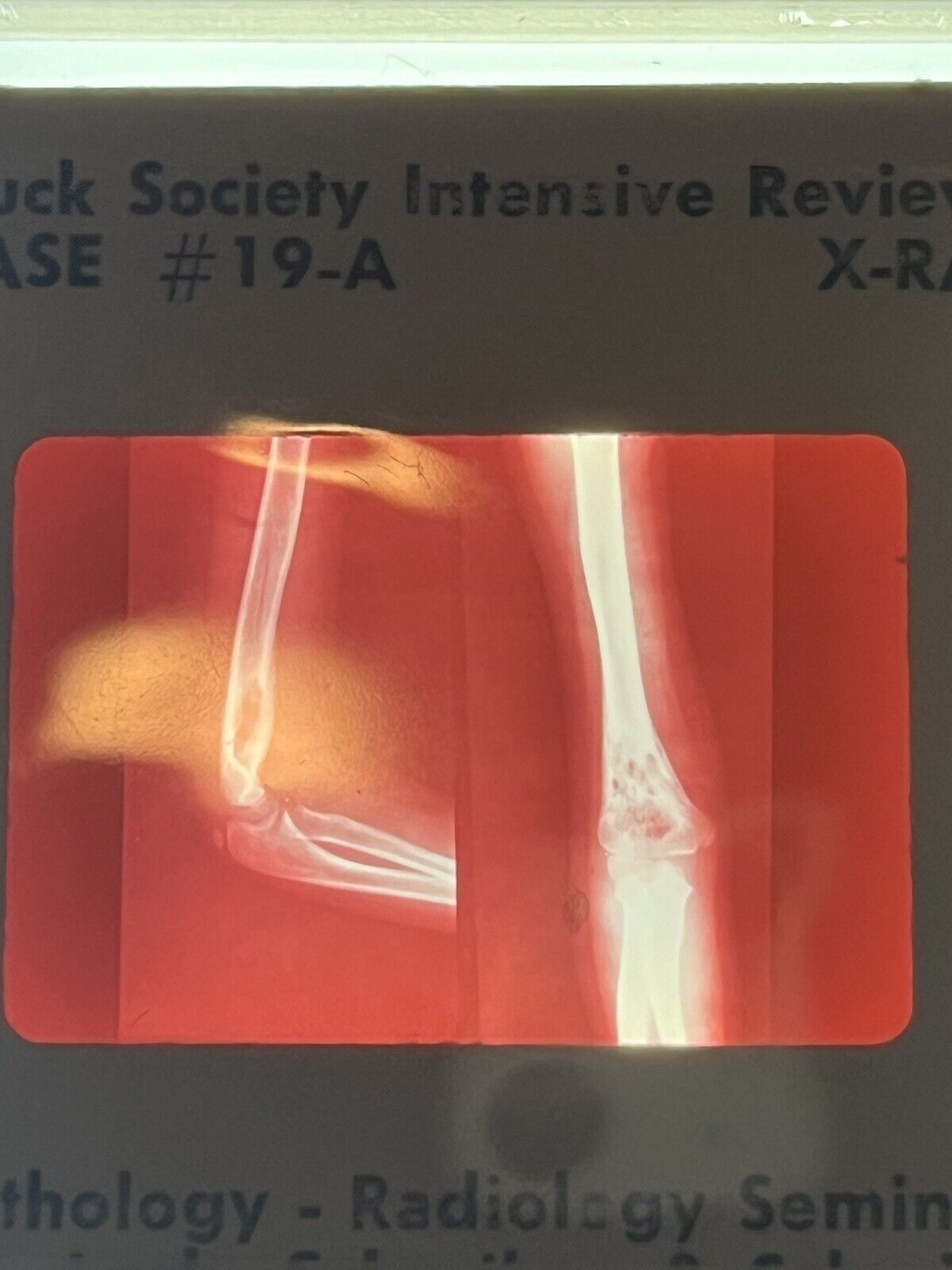 5787956