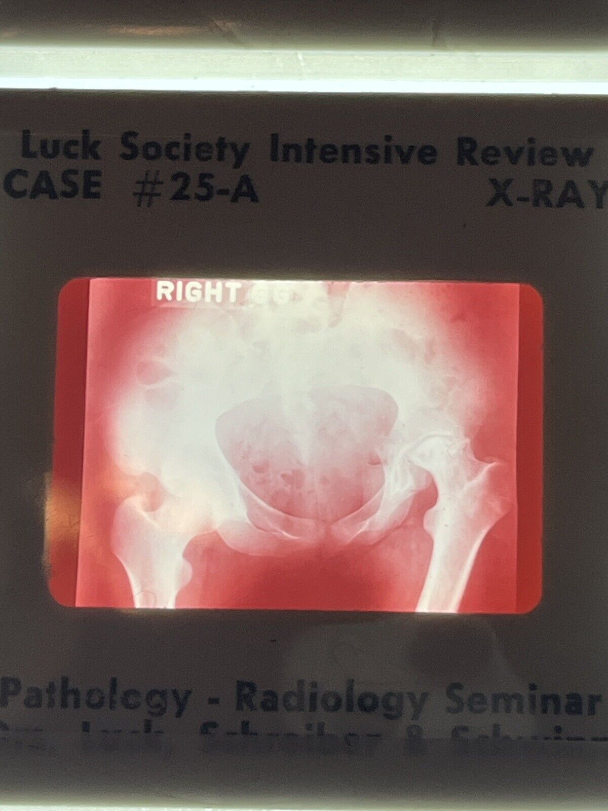 5787956